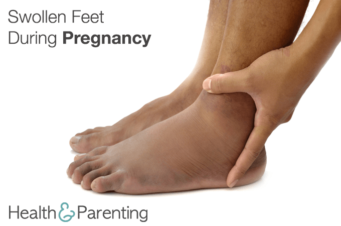 Swollen Feet During Pregnancy