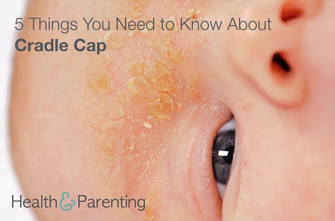 cradle cap in adults