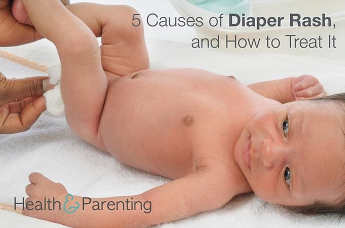 5 Causes of Diaper Rash, and How to Treat It
