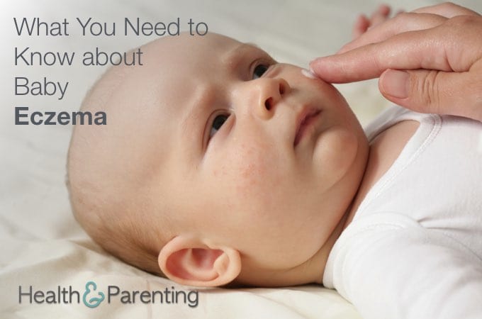 What You Need to Know About Baby Eczema
