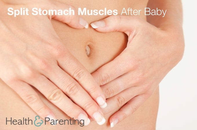 Split Stomach Muscles After Baby