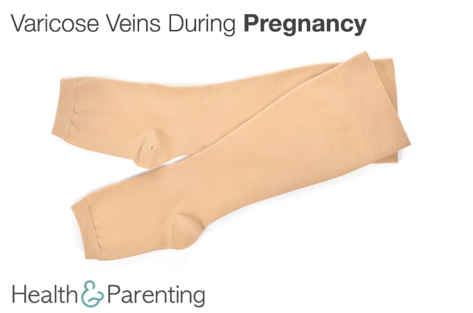 Varicose Veins During Pregnancy - Philips