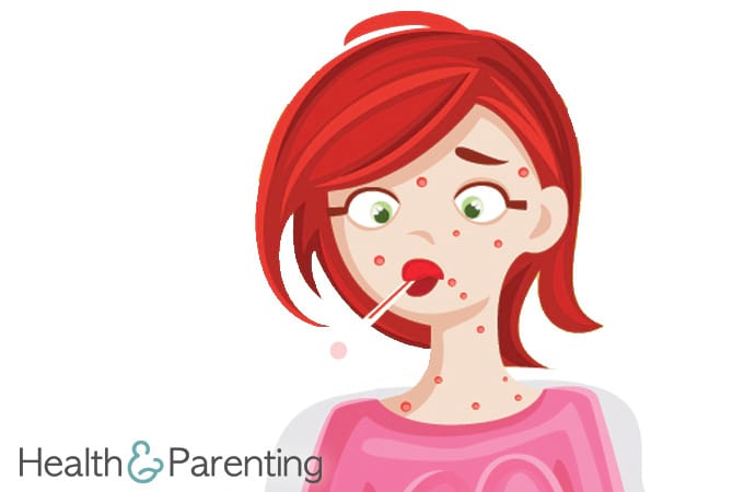 Chickenpox During Pregnancy